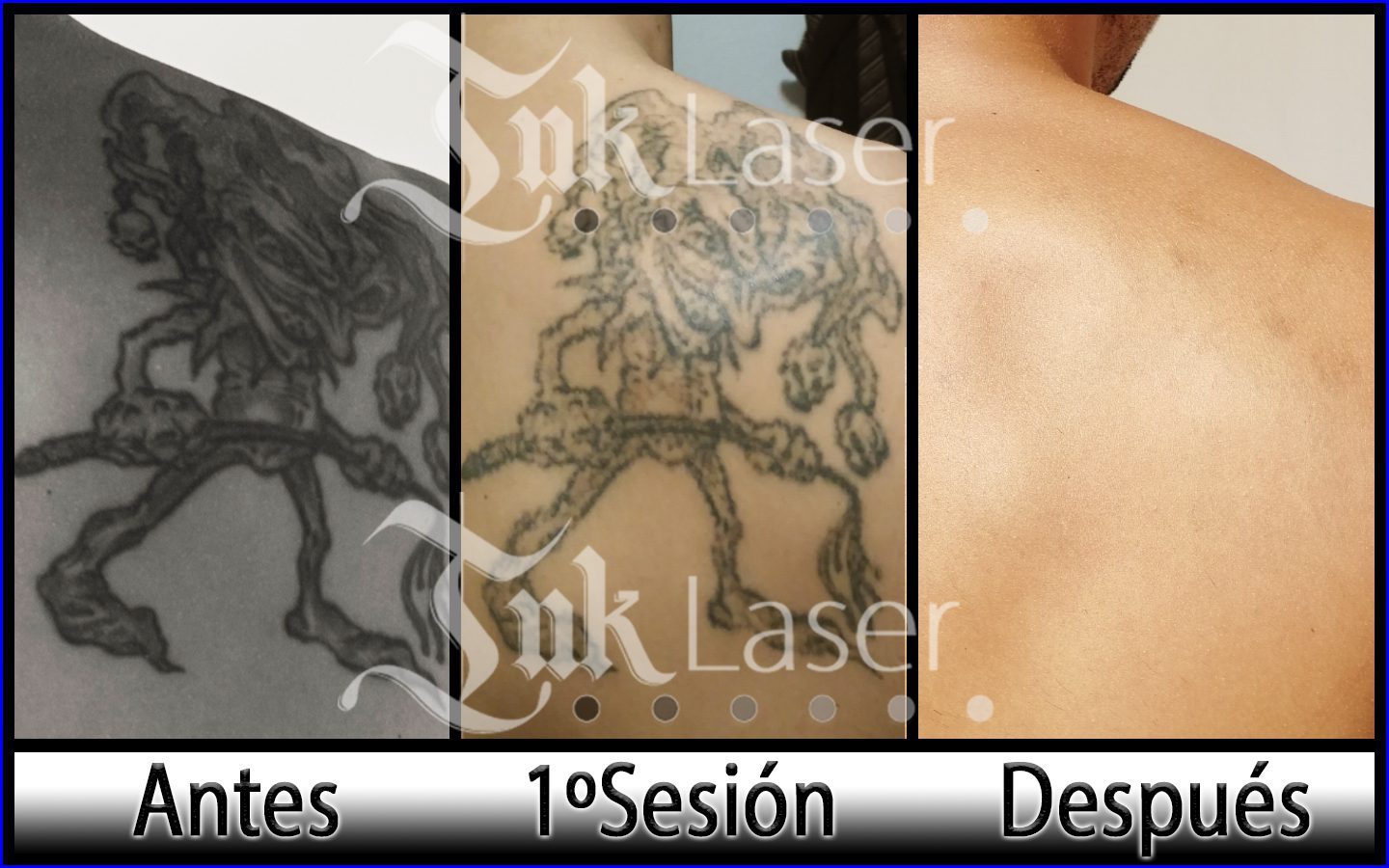 ¿Cuántas sesiones se necesitan para eliminar un tatuaje?