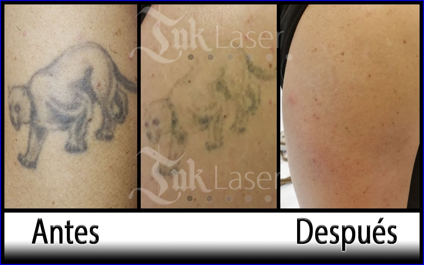 ¿Cuesta más de eliminar un tatuaje nuevo o uno viejo?
