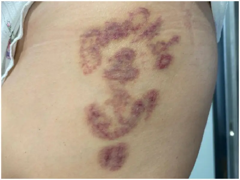 ampollas despues de laser tatuaje