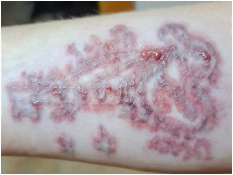 ampollas despues de laser tatuaje