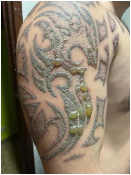 ampollas despues de laser tatuaje