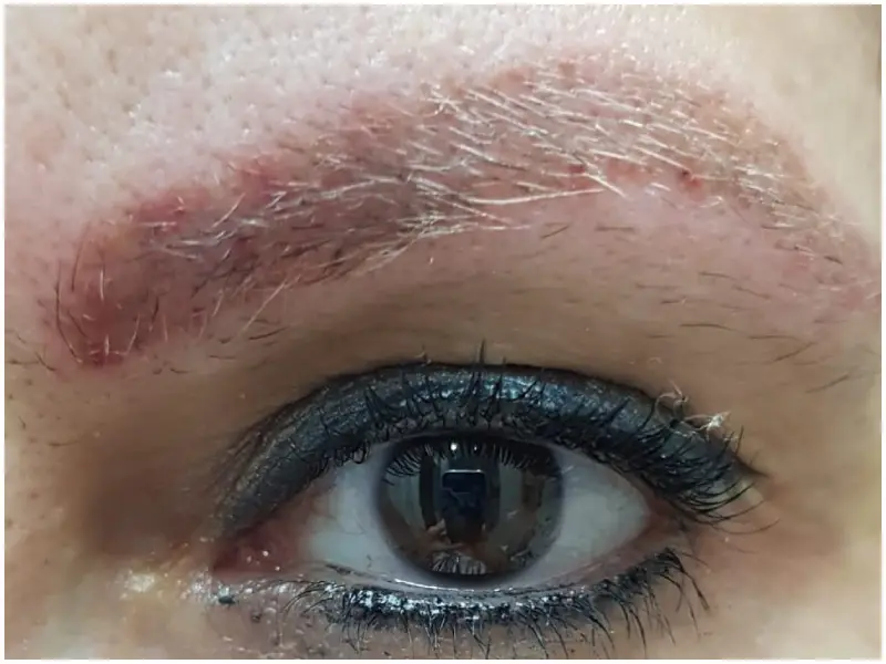 ampollas despues de laser tatuaje