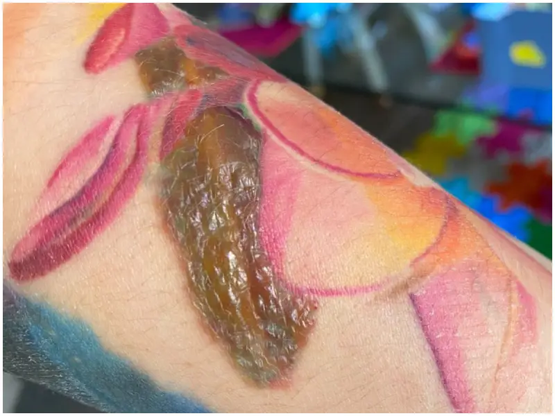 ampollas despues de laser tatuaje