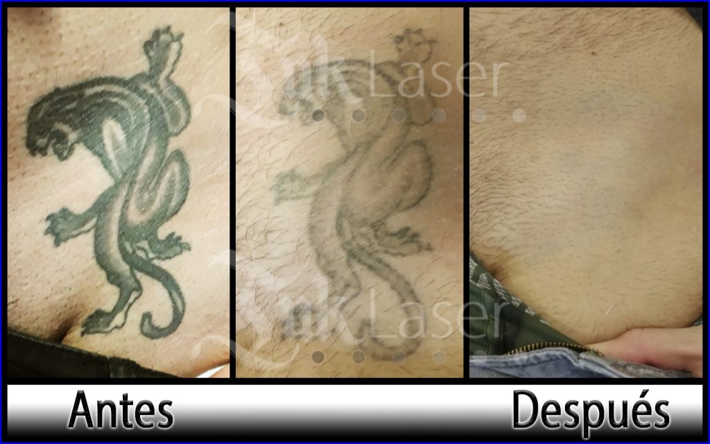 Eliminar tatuajes Alicante