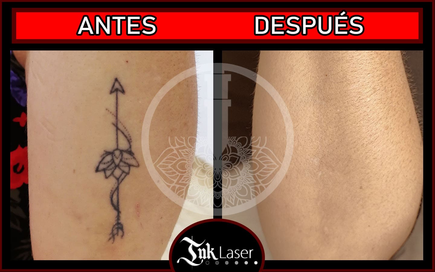 Laser tatuajes alicante