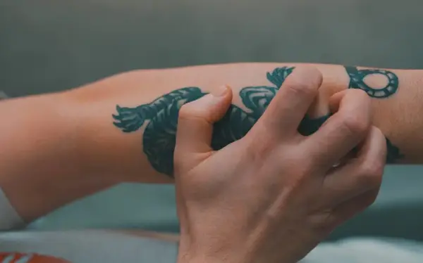 Picores tras quitar un tatuaje con láser