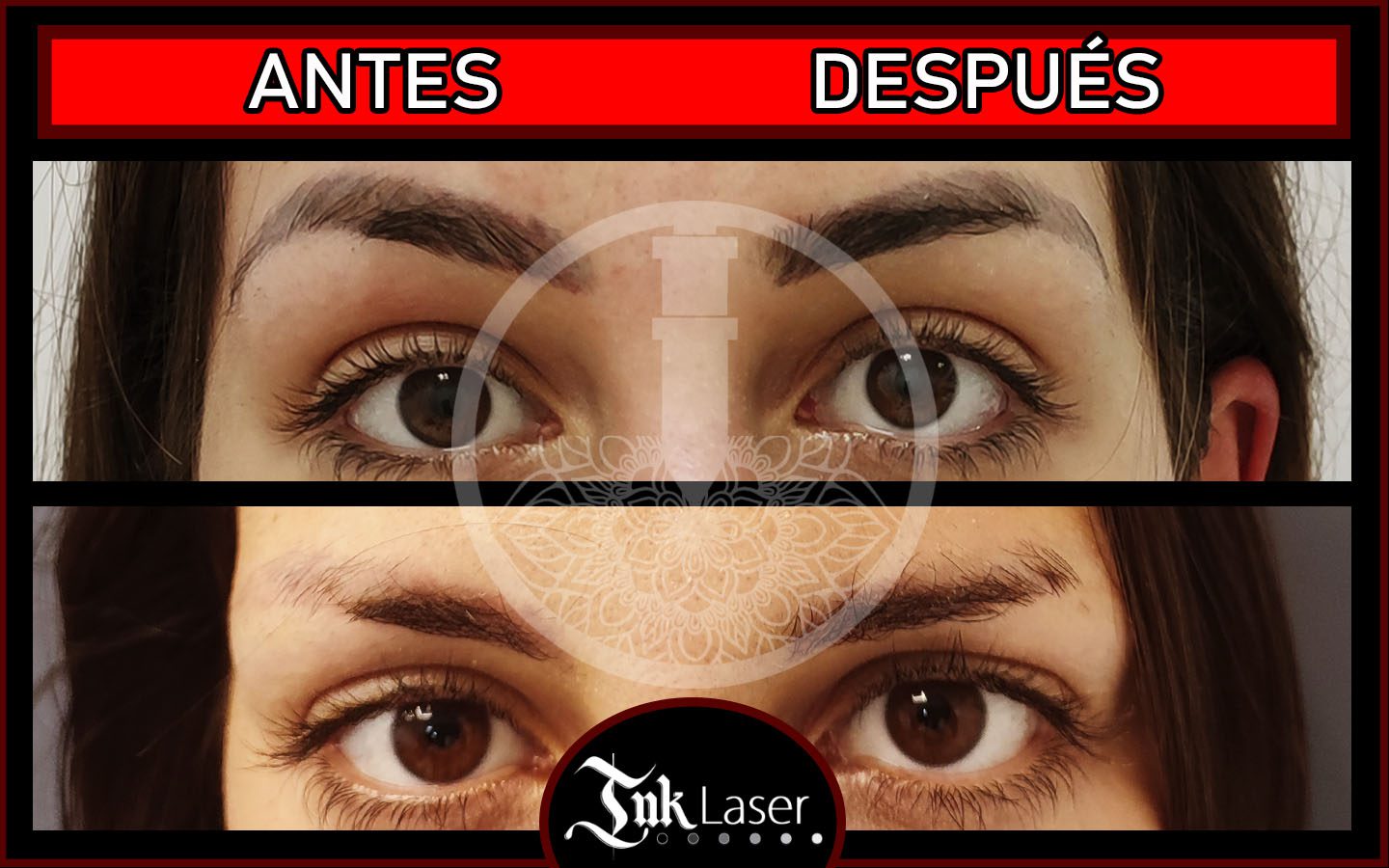 Microblading de cejas eliminado con láser en Ink Láser Alicante Microblading de cejas eliminado con láser en Ink Láser Alicante