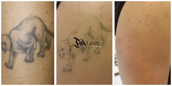 Cómo queda la piel después de quitarse un tatuaje