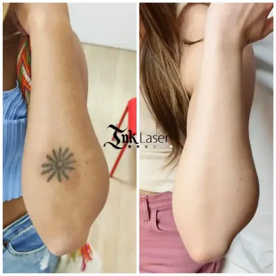 Cómo queda la piel después de quitarse un tatuaje