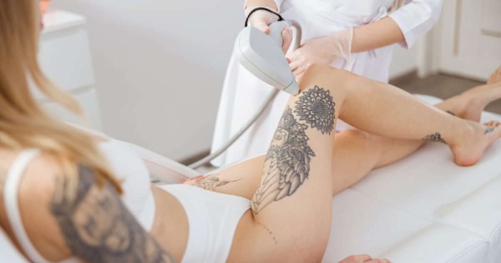 Depilación láser tatuajes
