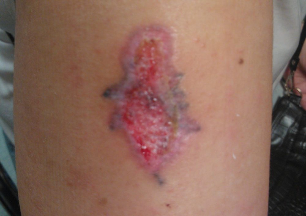 Quemadura depilación láser en tatuaje