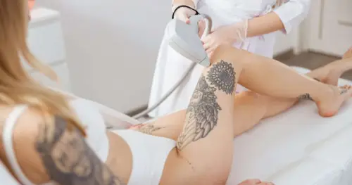 Depilación láser sobre un tatuaje borrado