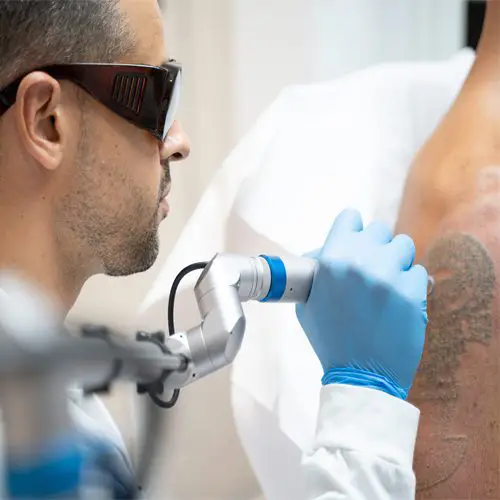 Ink Láser Alicante - Eliminar tatuajes