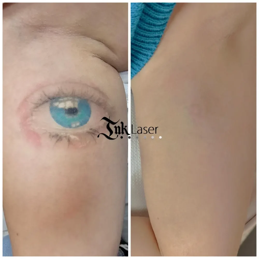Ink Láser Alicante - Eliminar tatuajes