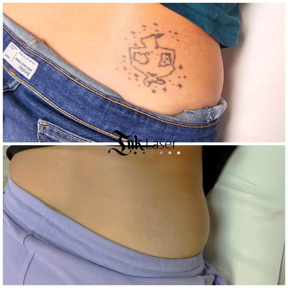 Ink Láser Alicante - Eliminar tatuajes