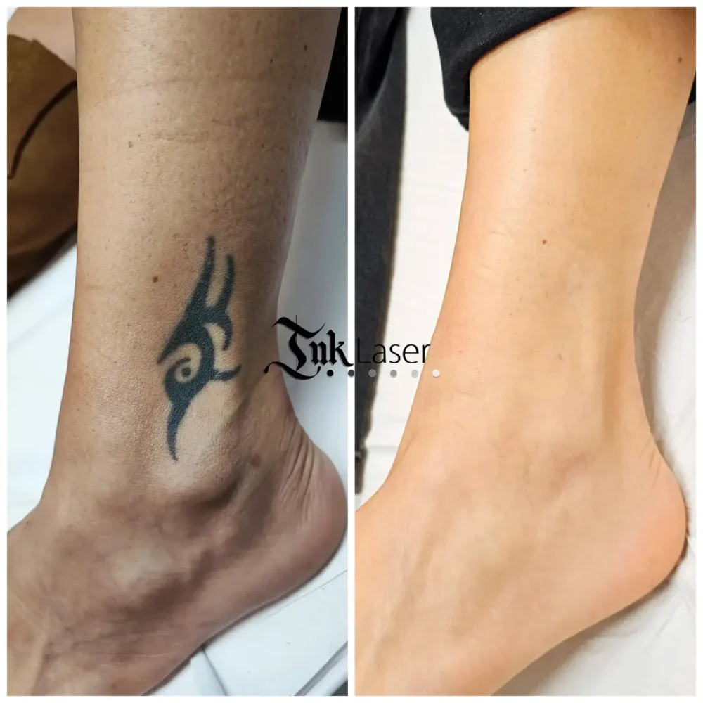Ink Láser Alicante - Eliminar tatuajes