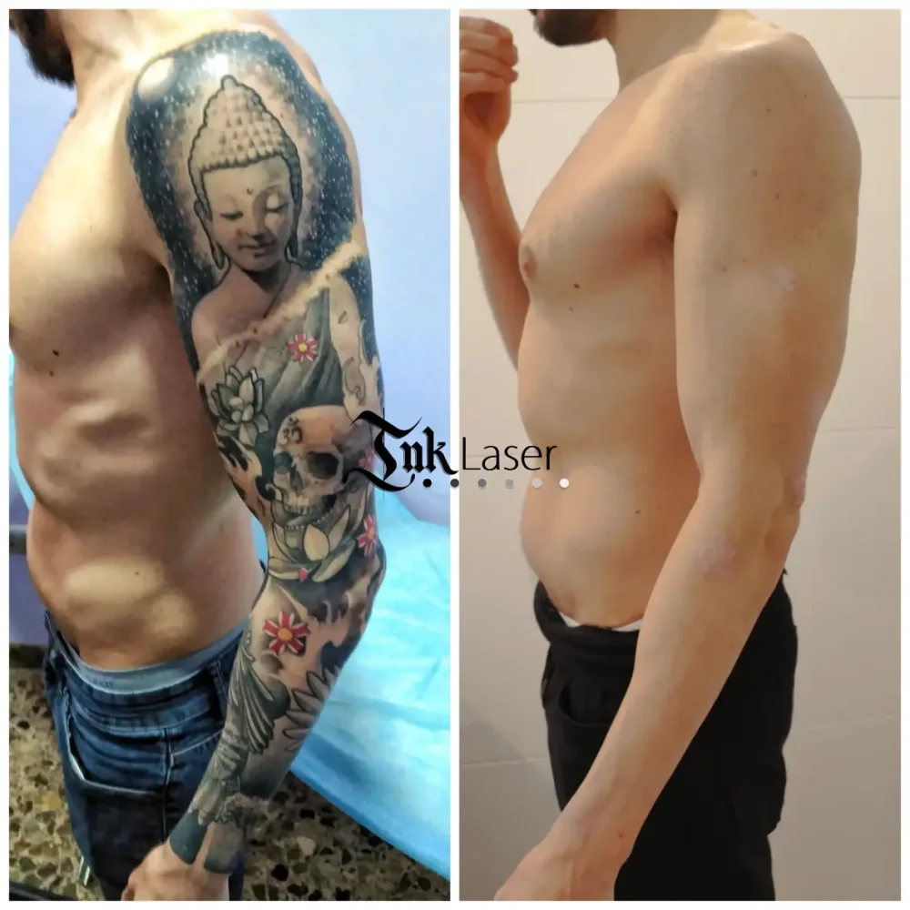Ink Láser Alicante - Eliminar tatuajes