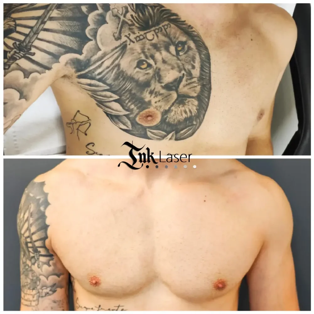 Ink Láser Alicante - Eliminar tatuajes