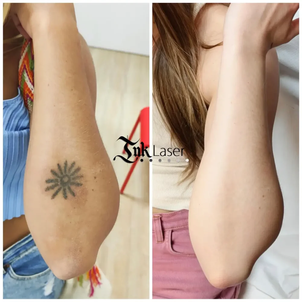 Ink Láser Alicante - Eliminar tatuajes