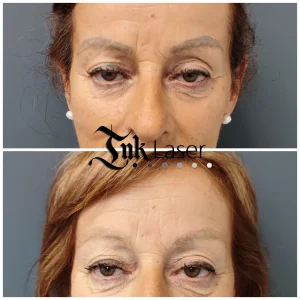 Eliminación de microblading