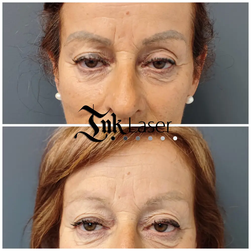 Eliminación de microblading