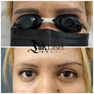 Eliminación de microblading