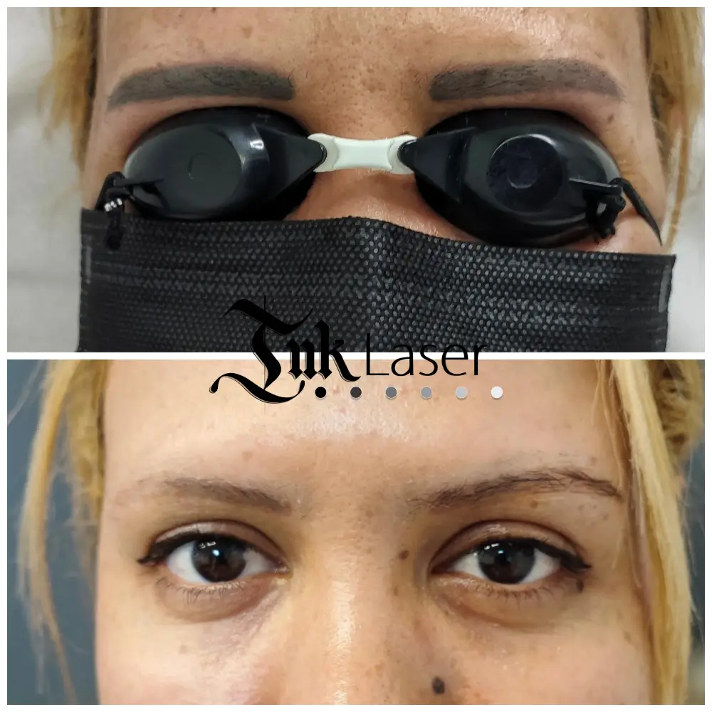 Eliminación de microblading