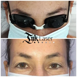 Eliminación de microblading