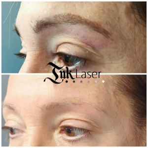 Eliminación de microblading