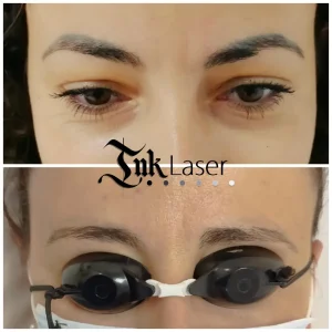 Eliminación de microblading