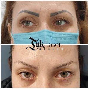 Eliminación de microblading