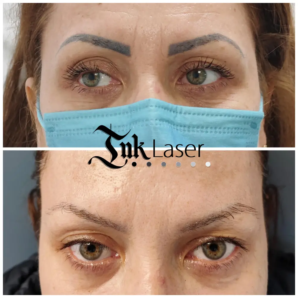 Eliminación de microblading